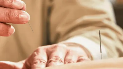 Acupuncture needles placed along a client's back during a traditional Chinese medicine treatment.